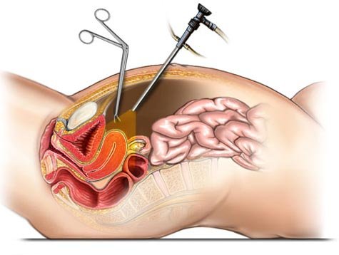 Uterus Removal Specialist In Nagpur